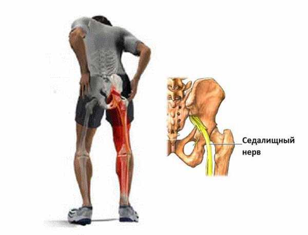 Защемление седалищного нерва: симптомы и лечение | Клиника Temed