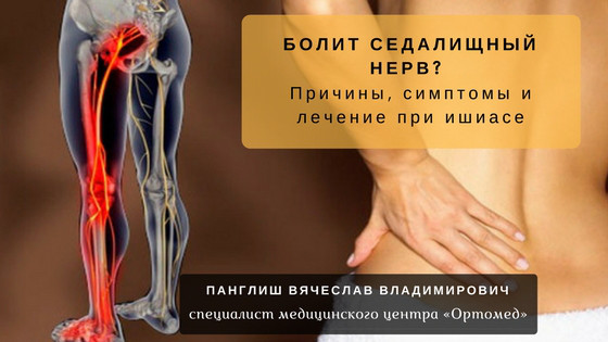 Седалищный Нерв Где Находится Фото Лечение
