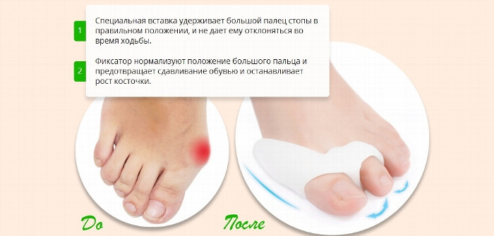 Фиксатор силиконовый от косточки на ноге Valgus Pro 2 штуки - фото 6 - id-p91001890