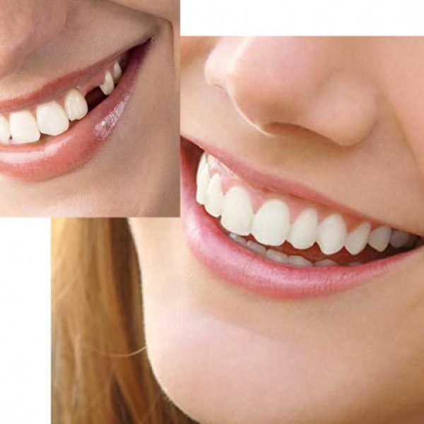 Набор для быстрой замены зуба Instant Smile Temporary Tooth Kit - фото 5 - id-p91221523