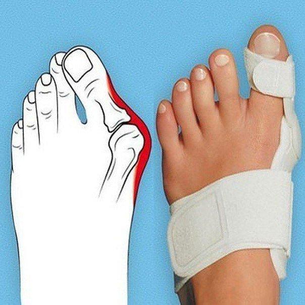 Бандаж на шарнирах косточки на пальце Hallufix Hallux Valgus.1 штука - фото 4 - id-p34616379