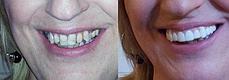 Накладные зубы - протезы для зубов Snap on smile верхние, фото 3