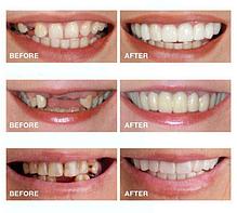 Съемные виниры Perfect Smile Veneers (верхняя) Надевай за 3 секунды в любом месте, исправь зубы без стоматолог, фото 2