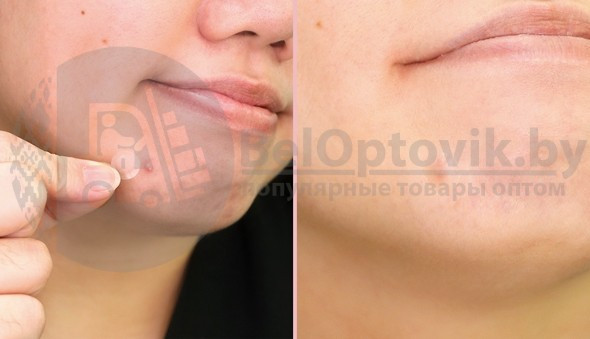 Противовоспалительные локальные патчи против акне Bye Bye Pimple Patch, 24 шт Original Korea - фото 4 - id-p119780831