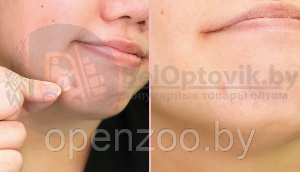 Противовоспалительные локальные патчи против акне Bye Bye Pimple Patch, 24 шт Original Korea - фото 4 - id-p119823064