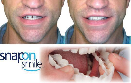 Набор для ВЕРХНИХ и НИЖНИХ зубов. Накладные зубы Snap on Smile - фото 7 - id-p126476287