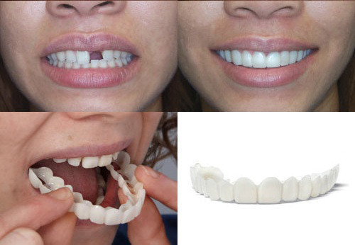 Набор для ВЕРХНИХ и НИЖНИХ зубов. Накладные зубы Snap on Smile - фото 9 - id-p126476287