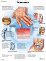 Плакат "Ревматизм"
