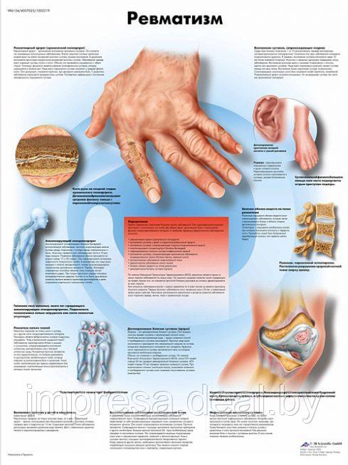 Плакат "Ревматизм" - фото 1 - id-p131055298