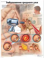 Плакат "Заболевания среднего уха"