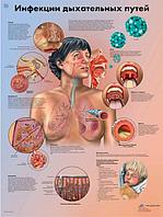 Плакат "Инфекции дыхательных путей"