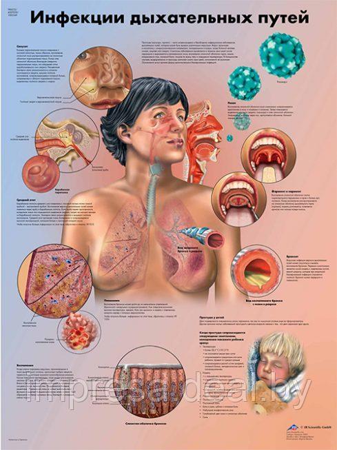 Плакат "Инфекции дыхательных путей" - фото 1 - id-p131055314