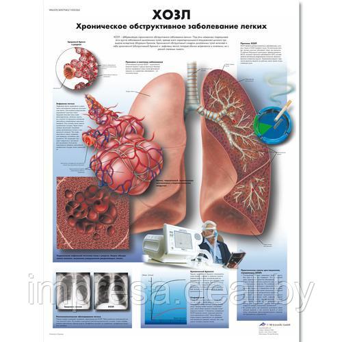 Плакат "ХОЗЛ - хроническое обструктивное заболевание легких" - фото 1 - id-p131055320