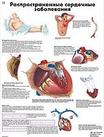Плакат "Распространенные сердечные заболевания"