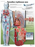 Плакат "Тромбоз глубоких вен"