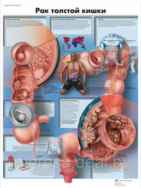 Плакат "Рак толстой кишки" - фото 1 - id-p131055328
