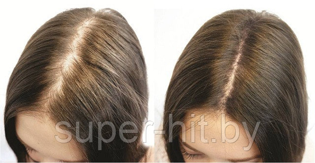 Эксидерм (средство для роста волос) 200 мл - фото 3 - id-p143425189