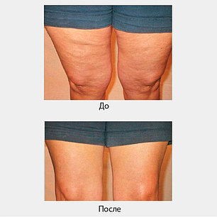 Пластырь от целлюлита Instant Thigh Lift, фото 2