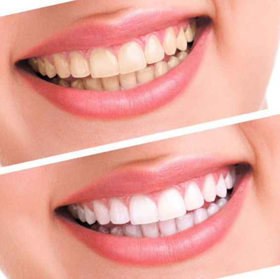Набор для отбеливания зубов Spin Smile 360 Professional Grade Tooth Polisher - фото 4 - id-p143823694