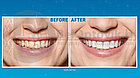Набор для отбеливания зубов Spin Smile 360 Professional Grade Tooth Polisher, фото 4