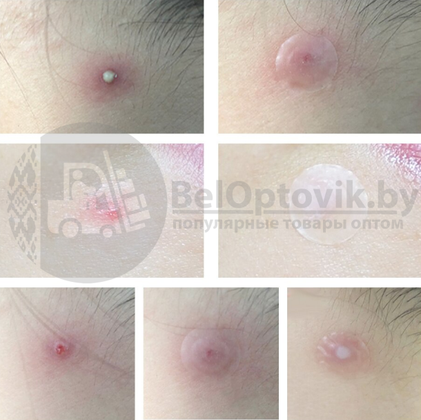 Стикеры - патчи (наклейки - пластыри) от прыщей и угрей Lanbena Acne Pimple Patch - фото 6 - id-p164847129