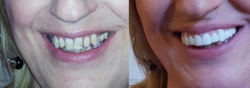 Накладные зубы (виниры) Snap on smile декоративные верх - фото 3 - id-p169067274