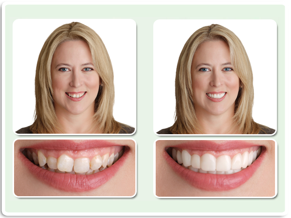 Накладные зубы (виниры) Snap on smile декоративные верх - фото 7 - id-p169067274