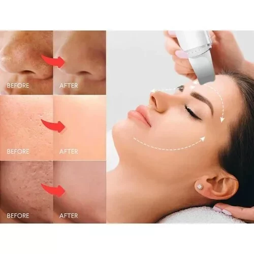 Ультразвуковой скребок для кожи Face Skin Cleaning Scrubber (Розовый) - фото 2 - id-p169216070