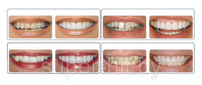 Накладные зубы Snap on Smile - Съемные виниры (ID#93060166), цена: 18. ...