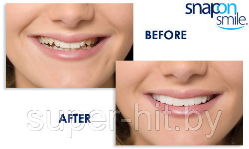 Накладные зубы Snap on Smile - Съемные виниры Для нижнего ряда зубов - фото 1 - id-p170604152