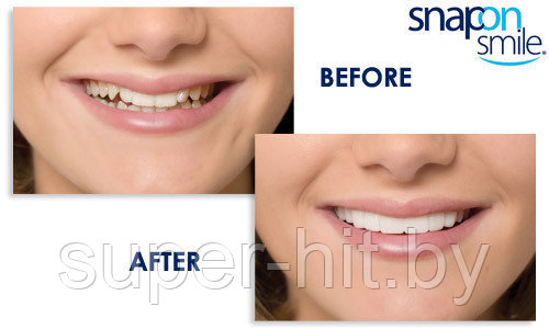 Накладные зубы Snap on Smile - Съемные виниры Для верхнего и нижнего ...