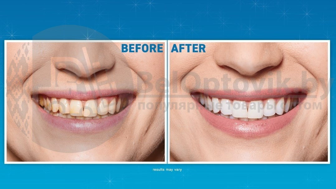 Набор для отбеливания зубов Spin Smile 360 Professional Grade Tooth Polisher - фото 4 - id-p179625302