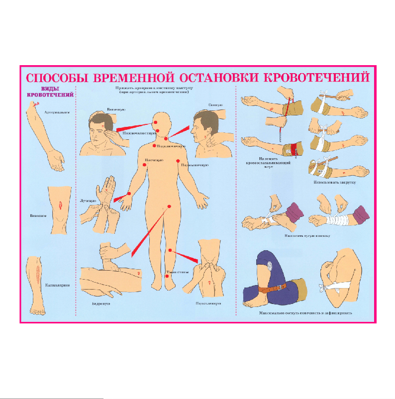 Информационный стенд "Cпособы временной остановки кровотечений" - фото 1 - id-p181786816