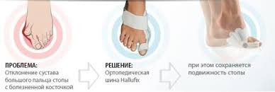 Шарнирная шина HALLUX VALGUS для коррекции большого пальца стопы - фото 7 - id-p185067496