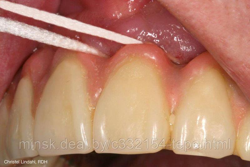 Зубная нить ТеРе Bridge & Implant Floss, 5 нитей в упаковке - фото 2 - id-p105457449