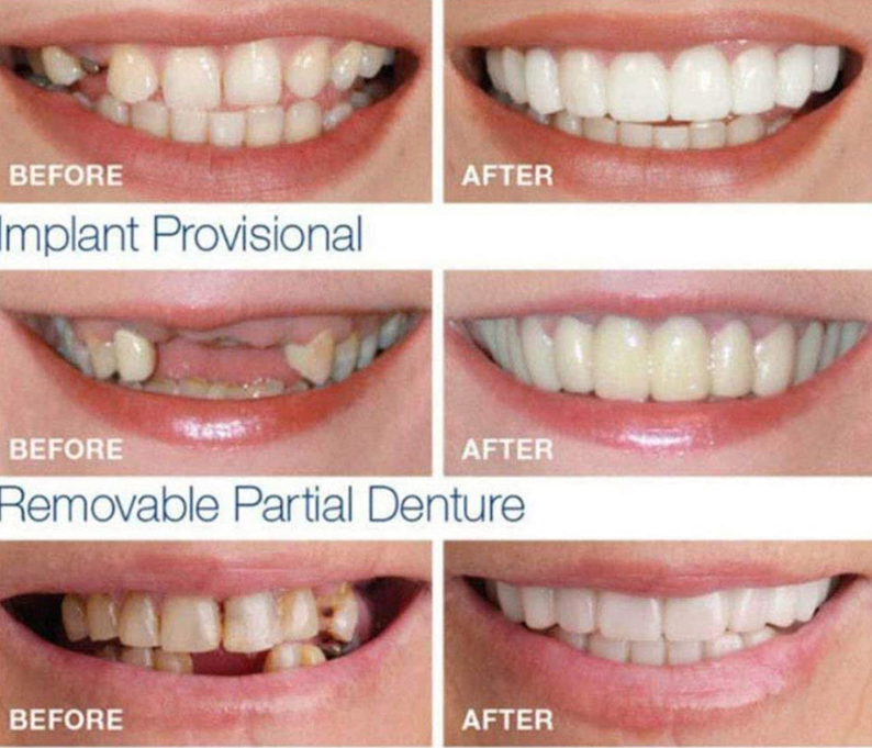 Накладные виниры для зубов Snap-On Smile / Съемные универсальные виниры для ослепительной улыбки 2 шт. (на две - фото 10 - id-p207134866