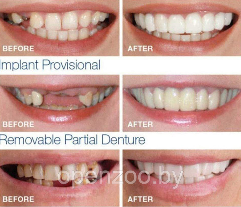 Накладные виниры для зубов Snap-On Smile / Съемные универсальные виниры для ослепительной улыбки 2 шт. (на две - фото 10 - id-p207593266