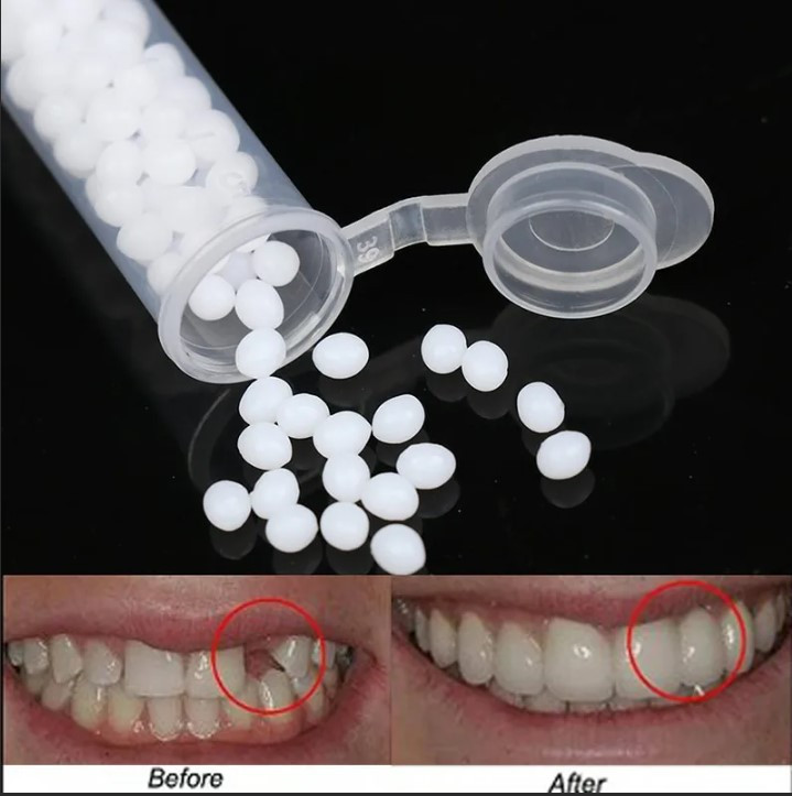 Клей для виниров (временного восстановления зубов) (~3 гр.) - фото 1 - id-p135353719