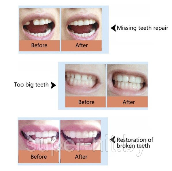 Клей для виниров (временного восстановления зубов) (~3 гр.) - фото 6 - id-p210197651