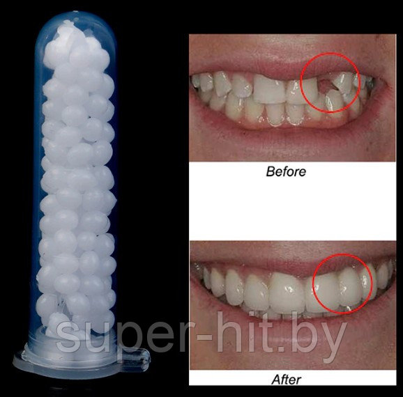 Клей для виниров (временного восстановления зубов) (~3 гр.) - фото 10 - id-p210197651