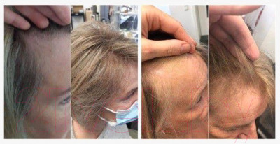 Эссенция для волос Inclip Кислородная 5 от выпадения и для роста волос - фото 3 - id-p223882488