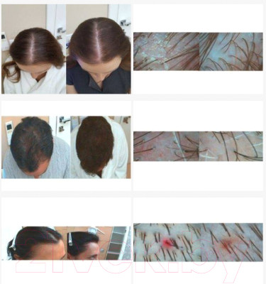 Эссенция для волос Inclip Кислородная 5 от выпадения и для роста волос - фото 4 - id-p223884232