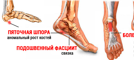 Доктор Акула Шпорамаз гель для растирания ног в области пятки Акулий жир и Золотой ус 75 мл - фото 3 - id-p225265874