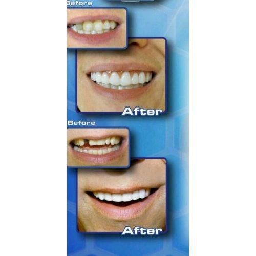 Съемные виниры Голливудская улыбка Perfect Smile Veneers - фото 6 - id-p225499461