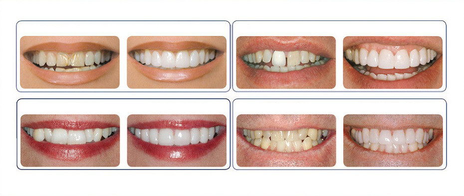 Накладные зубы (виниры) Snap on smile декоративные верх - фото 5 - id-p225501543