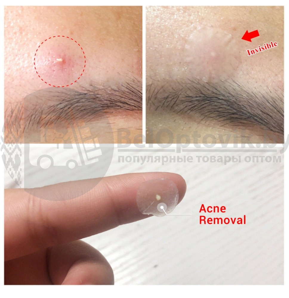 Стикеры - патчи (наклейки - пластыри) от прыщей и угрей Lanbena Acne Pimple Patch - фото 4 - id-p225501264