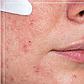 Крем для кожи с розацеа SkinClinic Rosanic cream 50мл, фото 2