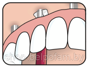 Зубная щетка Тере Implant care - фото 4 - id-p39333329