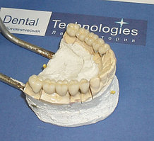 Металлокерамические зубные протезы