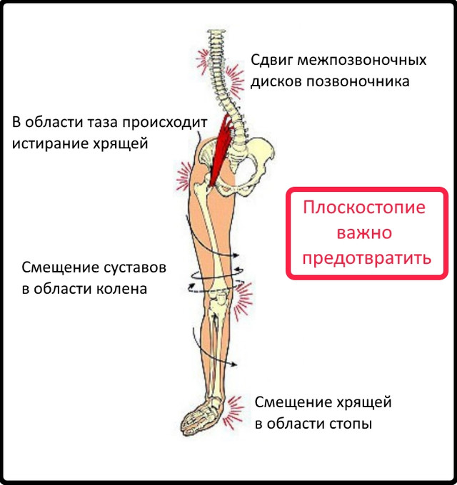 Плоскостопие важно предотвратить